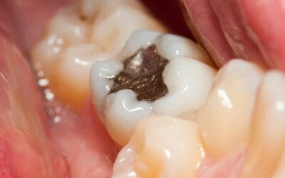 Understanding Fillings Dental Costs: What to Expect